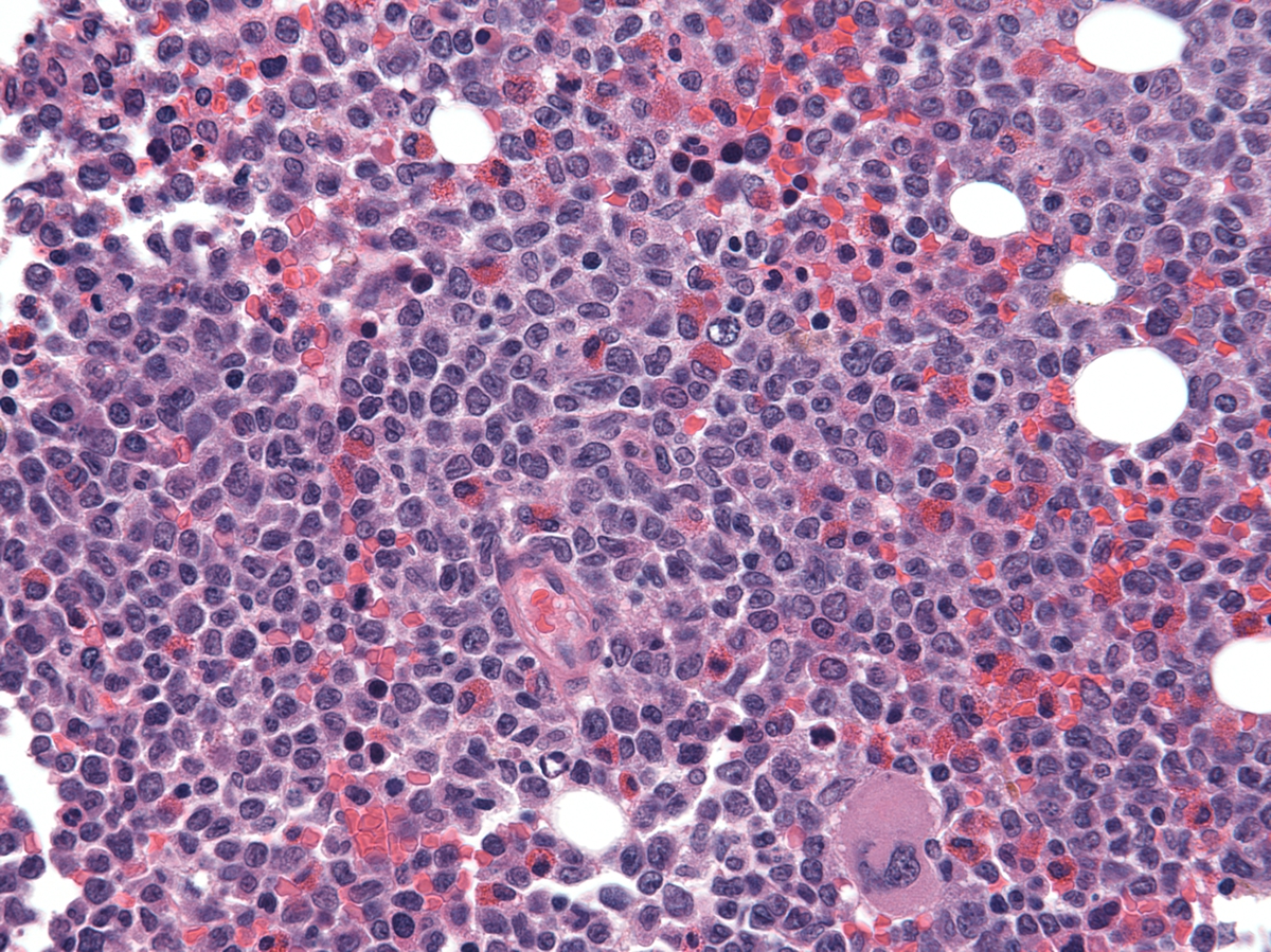 core biopsy with blasts and eosinophils, 1 month after gastric biopsy